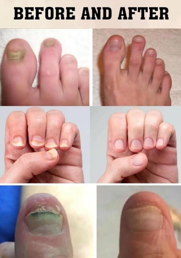 Essential Oil Fight Nail Fungus I Made in USA | Pure Natural Ingredients I Ultimate Strength Superb Performance | Promotes Healthy Nail | Renew | Restore Weak & Discolored Nails 14 ML