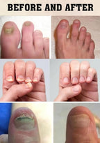 Essential Oil Fight Nail Fungus I Made in USA | Pure Natural Ingredients I Ultimate Strength Superb Performance | Promotes Healthy Nail | Renew | Restore Weak & Discolored Nails 14 ML