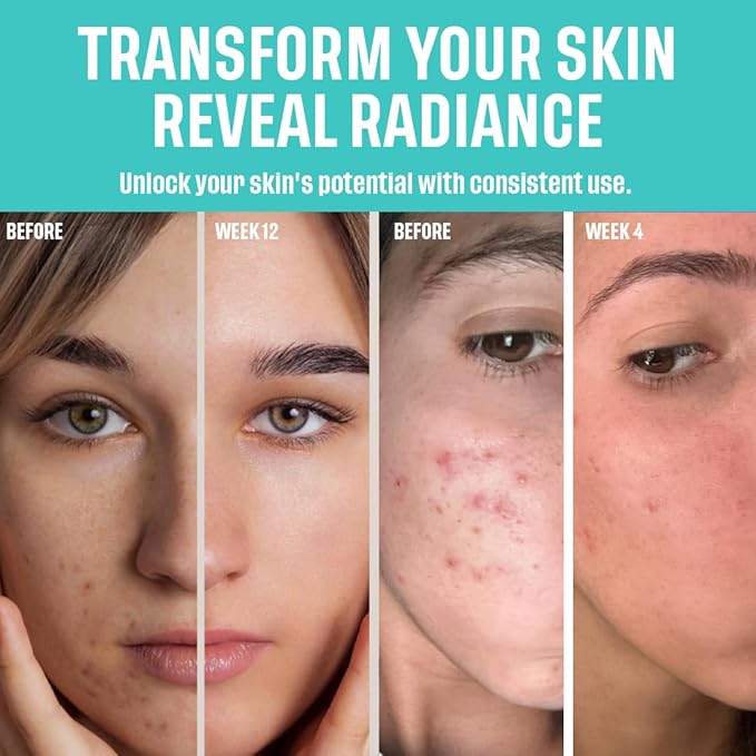 2% BHA AHA Liquid Salicylic Acid Exfoliant - Gentle Peel, Pore Minimizer, Face Exfoliator for blackheads, wrinkles with Hyaluronic acid - Fragrance-Free Hydrating for All Skin Types, 2oz