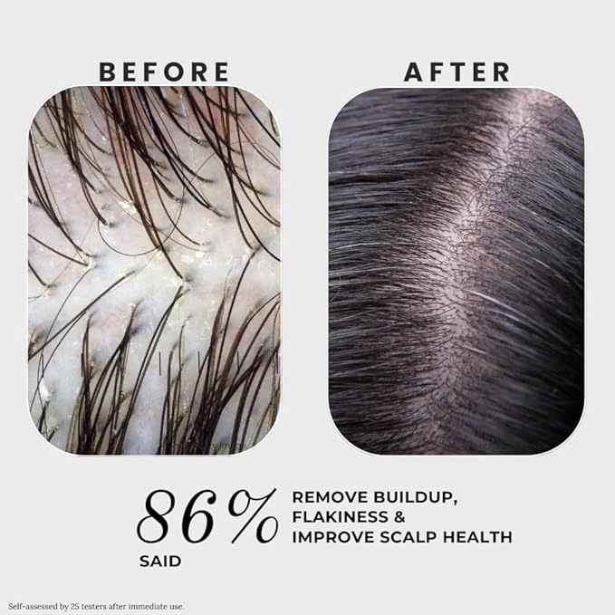 K C Scalp Detox & Hair Treatment Mask - Deep Conditioner for Dry Scalp & Damaged Hair – Scalp Care for Buildup, Flakes & Oil Control – All Hair/Scalp Types – Spa Grade Formula (FRESH)