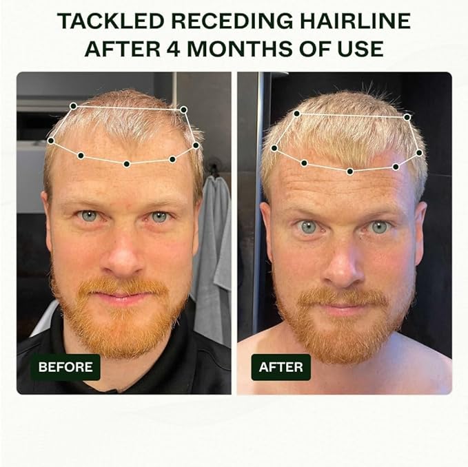 Scandinavian Biolabs Bio-Pilixin® Routine For Men | Helps With Hair Shedding, Nurtures Hair Follicles, Enhances Hair Strength, Repairs Damaged Hair, Clinically Tested, Dermatologically Approved