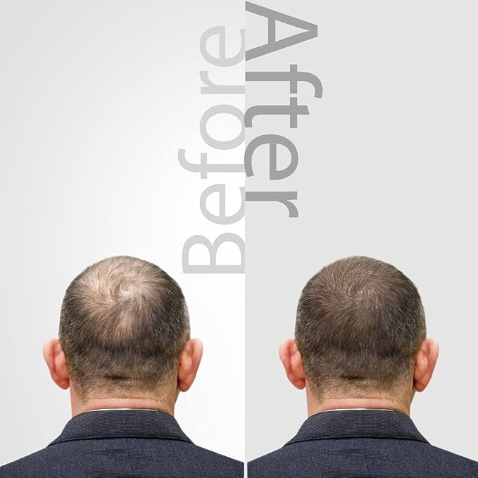 The Mossi London Ozonized Scalp Oil, Hair growth Complex, Hair oil for Dry Scalp, Hair Growth oil For Man, Woman, Scalp Treatment For Hair Growth, All Hair Types (1.01 fl Oz. - 30 ml)