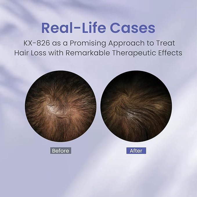 KINTOR 0.9% KX-826 Hair Regrowth Spray,Supporting Healthy Hair Growth,Oil Control, Hair Growth Products Group for Men&Women,Pro,60ml