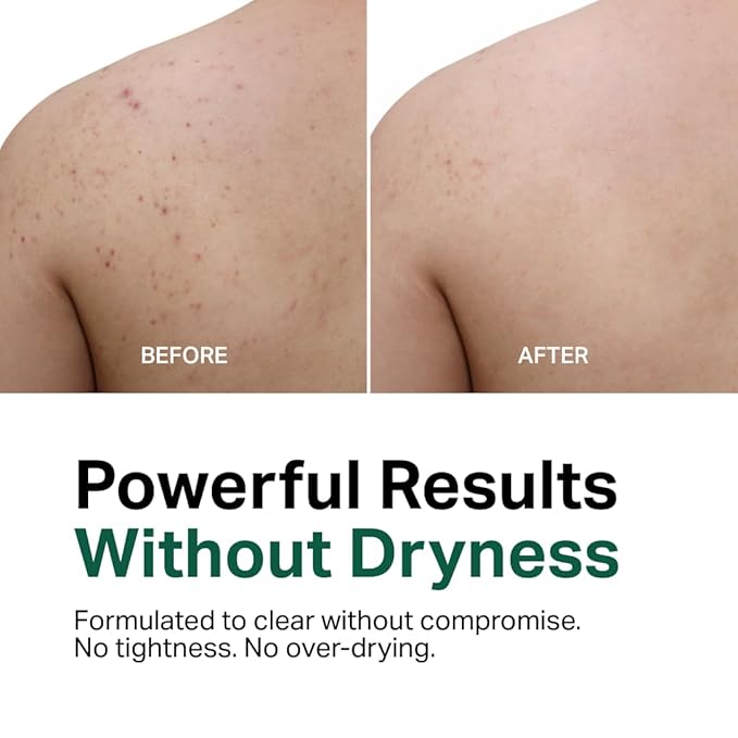 Y'OUR Acne Clearing Body Wash | Gentle & Non-Drying Salicylic Acid Formula | For All-Over Body Use - Smooths Texture & Evens Tone | Clears Bacne & Breakouts for Women + Men, Paraben & Sulfate Free