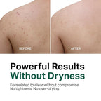 Y'OUR Acne Clearing Body Wash | Gentle & Non-Drying Salicylic Acid Formula | For All-Over Body Use - Smooths Texture & Evens Tone | Clears Bacne & Breakouts for Women + Men, Paraben & Sulfate Free