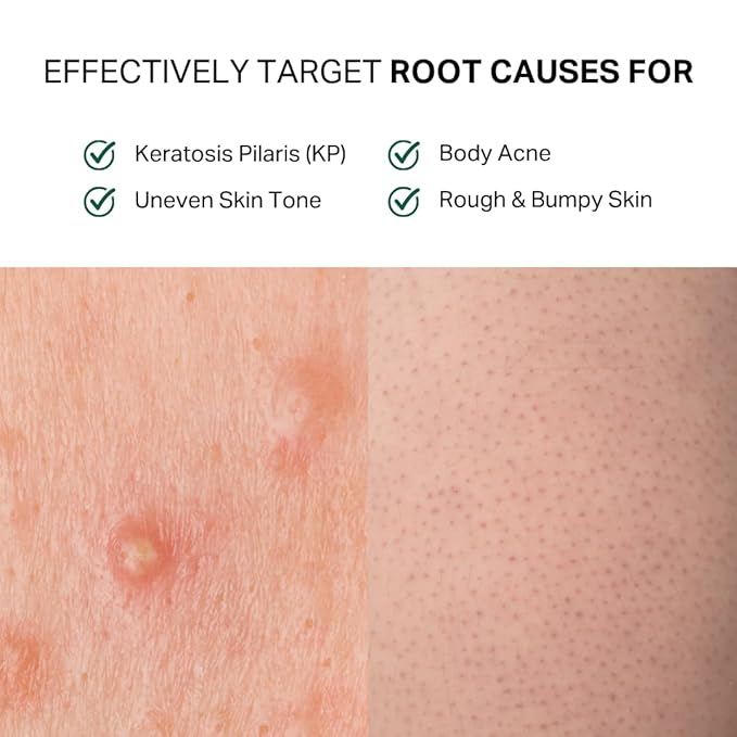 Y'OUR Acne Clearing Body Wash | Gentle & Non-Drying Salicylic Acid Formula | For All-Over Body Use - Smooths Texture & Evens Tone | Clears Bacne & Breakouts for Women + Men, Paraben & Sulfate Free