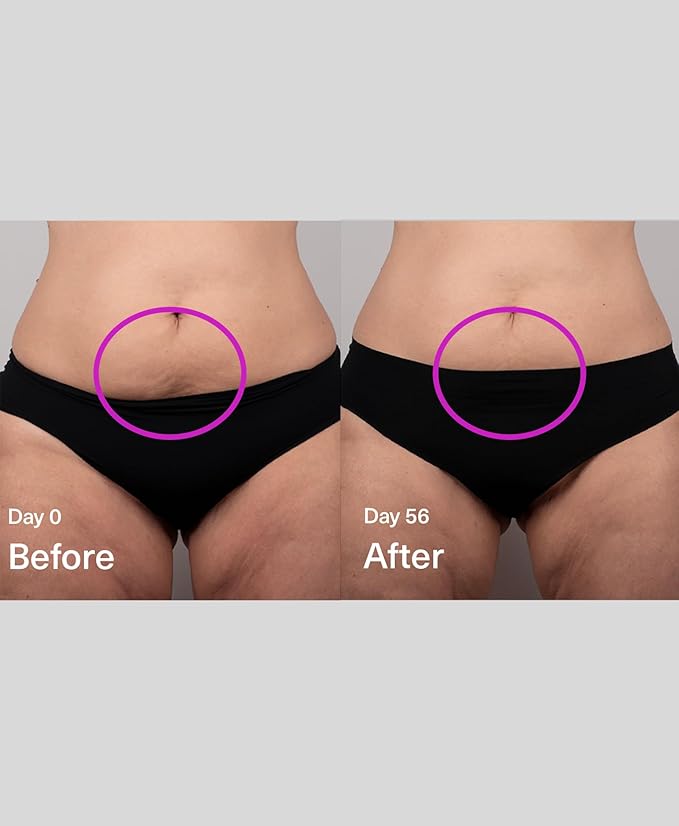 SickScience DropOff Advanced Exosome Body Firming & Sculpting Cream | Targets Stretch Marks, Cellulite, the Belly Area & Loose Skin, Including After Pregnancy, 100ml