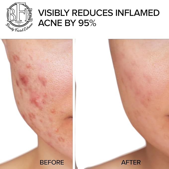 Acne Treatment Pads- Eliminates Cystic Breakouts, Oily Skin & Clogged Pores. Clear Pimple, Whitehead, Blackhead, Dark Spots & Improve Skin Texture.