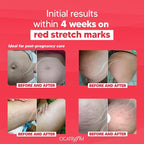 Cicatrissim Red Stretch Mark Cream for Red and Purple Striae - Softens Stretch Marks, Evens Skin Tone, and Firms Skin - All Skin Types - 150g