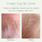 Yobee Ultra Gentle Soothing Scalp Mask - Dry Scalp Treatment Hair Mask Safe For Sensitive Baby Skin - Probiotic Infused - For Sensitive Scalp & Cradle Cap - For Babies, 4 fl oz