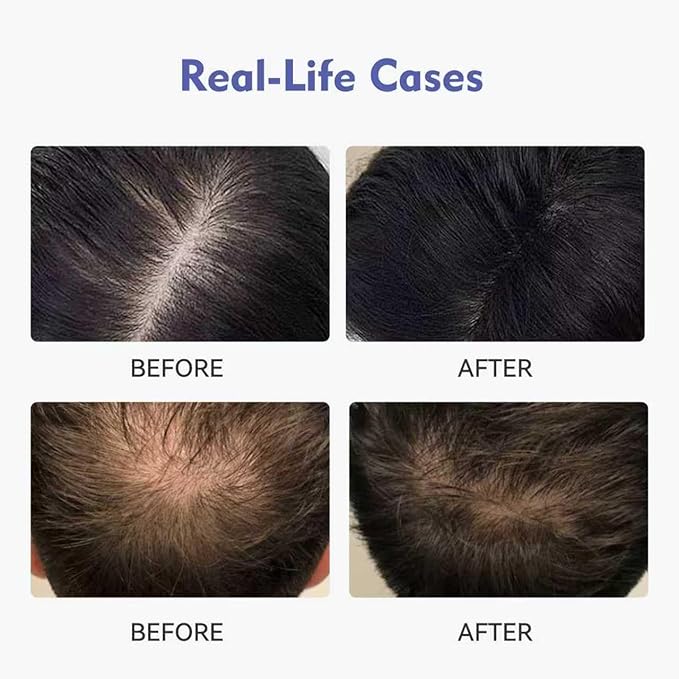 0.9% KX-826 KINTOR Hair Growth Products Foam, DHT Blocker for Men & Women Hair Regrowth, 300ml Pro