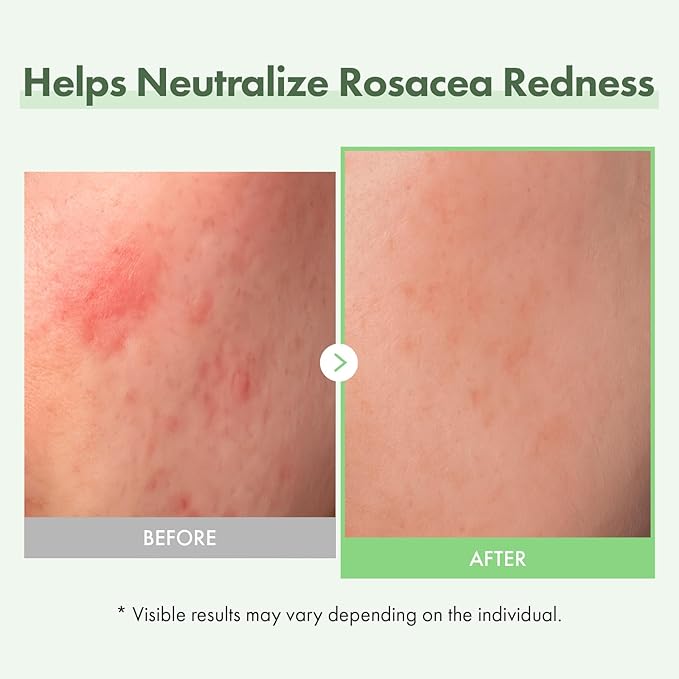 TOSOWOONG Azelaic Acid 10% Face Serum, Rosacea care, Redness Soothing and Blemish, Centella Asiatica for Acne-prone, Niacinamide, Hyaluronic Acid, Korean Skincare, Natural Color, 33 ml / 1.11 fl. oz.