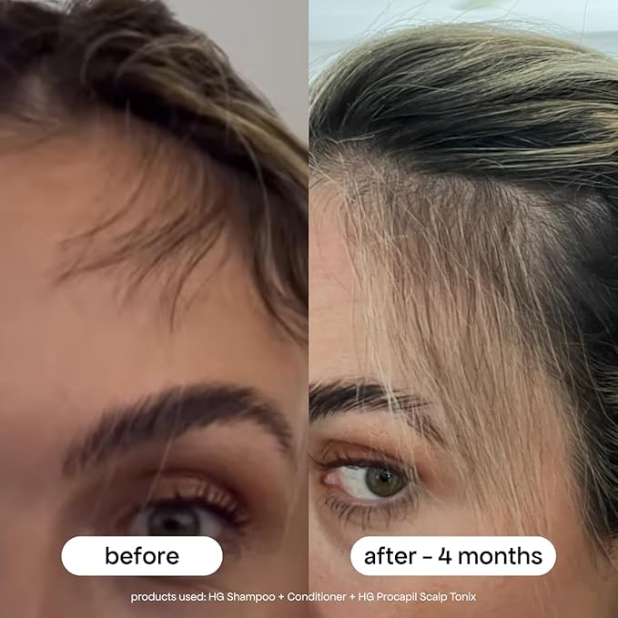 BONDIBOOST HG Anti-Thinning Hair Conditioner [10.14 fl oz] - Hydrating Hair Conditioner with Aloe Vera, Rosemary & Saw Palmetto, Promotes Thicker + Stronger-Looking Hair for Men & Women, Sulfate-Free