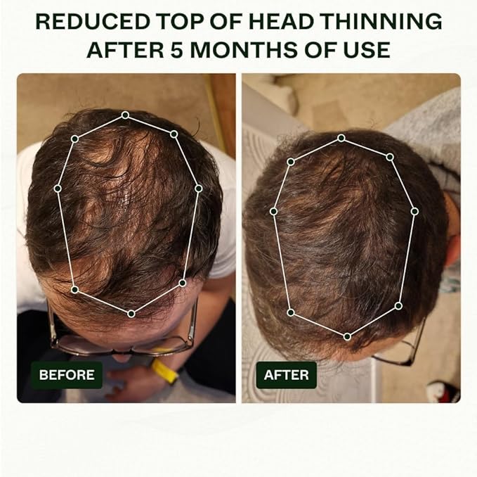 Scandinavian Biolabs Bio-Pilixin® Routine For Men | Helps With Hair Shedding, Nurtures Hair Follicles, Enhances Hair Strength, Repairs Damaged Hair, Clinically Tested, Dermatologically Approved