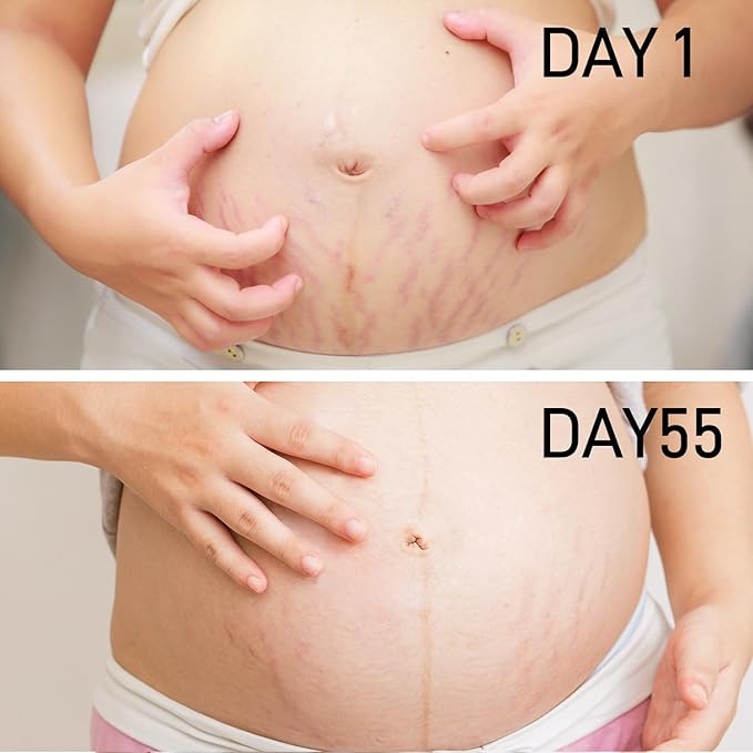 PEGO Stretch Mark Oil for Pregnancy, Maternity Body Oil for Stretch Mark Prevention & Reduction, Hydrating Skin Care, 5.41oz (Oil+Cream)