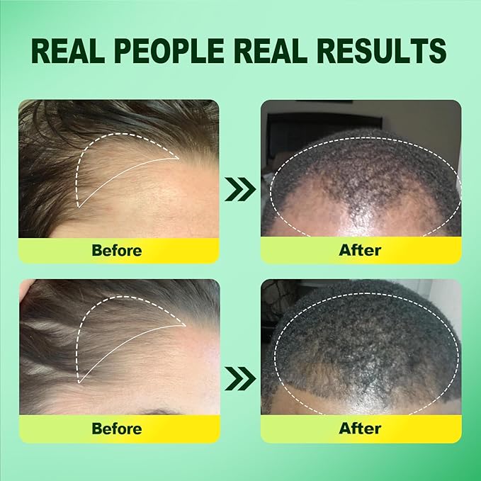 5% Minoxidil for Men, Minoxidil for Women Hair Growth Products, Extra Strength Minoxidil Topical Hair Loss Regrowth Treatment Serum with Rosemary & Biotin, Upgraded formula light & Non-Greasy 2Pack