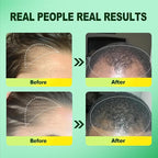 5% Minoxidil for Men, Minoxidil for Women Hair Growth Products, Extra Strength Minoxidil Topical Hair Loss Regrowth Treatment Serum with Rosemary & Biotin, Upgraded formula light & Non-Greasy 2Pack