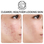 Acne Treatment Pads- Eliminates Cystic Breakouts, Oily Skin & Clogged Pores. Clear Pimple, Whitehead, Blackhead, Dark Spots & Improve Skin Texture.