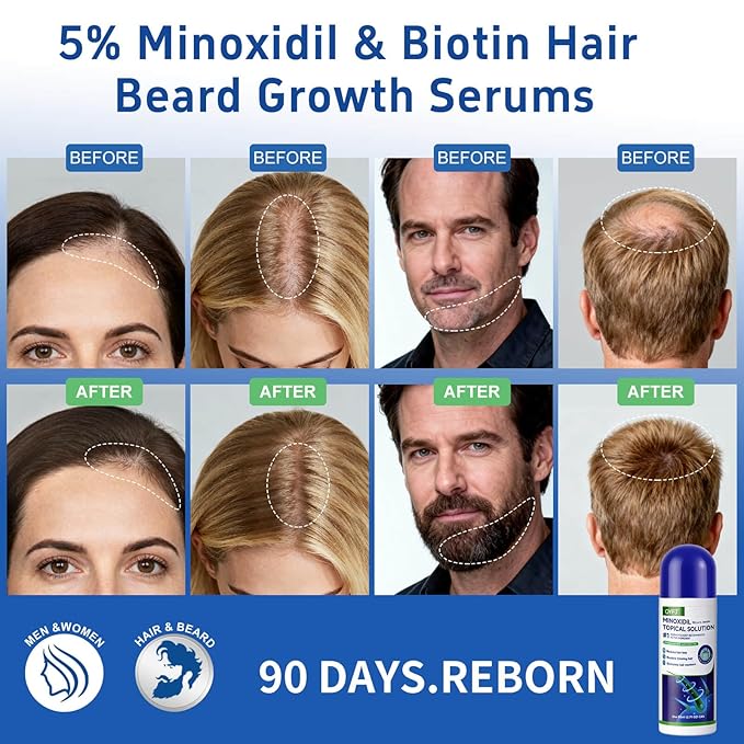 5% Minoxidil for Women& Men, Minoxidil Hair Growth Serum(Biotin-Infused) with Sponge Applicator for Thinning Hair& Receding Hairline, 8 Month Supply-6 x 2.71Fl oz