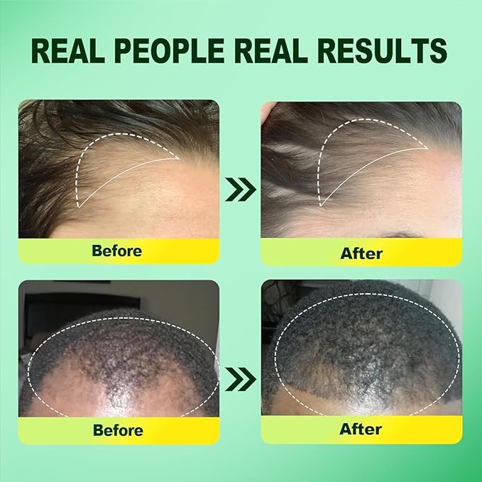 5% Minoxidil for Men, 3PCS Minoxidil for Women Hair Growth Products, Extra Strength Minoxidil Topical Hair Loss Regrowth Treatment Serum with Rosemary & Biotin, Upgraded formula light & Non-Greasy