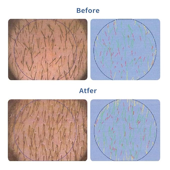 Hair Growth Serum Roll-On 30ml | Patented Blend with 3% Rosemary, 3% Redensyl, 2% AnaGain, Biotin & Niacinamide | No-Rinse, Fast-Absorbing | For Thinning Hair & All Hair Types (1.01 Fl Oz (Pack of 1))