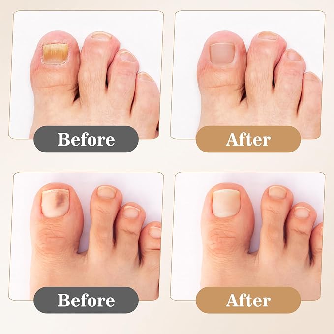 200 Pcs Nail Repair Patches, Muti-Purpose Fungus Nail Treatment Patch,Toenail Care for Toenail Fingernails,8-Hour Nighttime Renewal Toenails Fungus Patches for Damaged & Discolored Appearance Nails