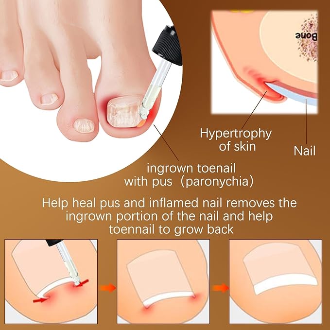2PCS Paronychia Nursing Oil, German Toenailcare Anti Paronychia Relief Oil, Repair for Damaged Discolored Thick Nails