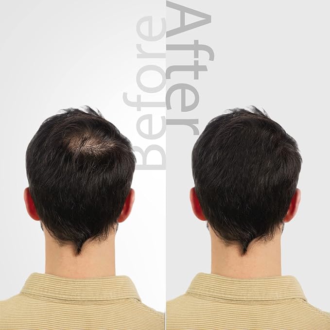 The Mossi London Hair Spray Serum 60Ml For Hair Regrowth - Prevents Post-Transplant Hair Loss - Stimulates New Hair Growth - Fast and Effective Results