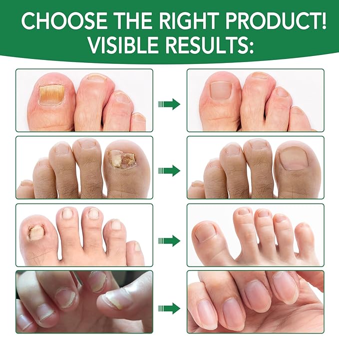 2Pack Toenail Treatment with 25% Undecylenic Acid, Nail Renewal, Promotes Nail Health,Enrich jojoba oil and vitamin E nourish the nail and & Skin,Safe & Gentle Repairing Damaged Nails