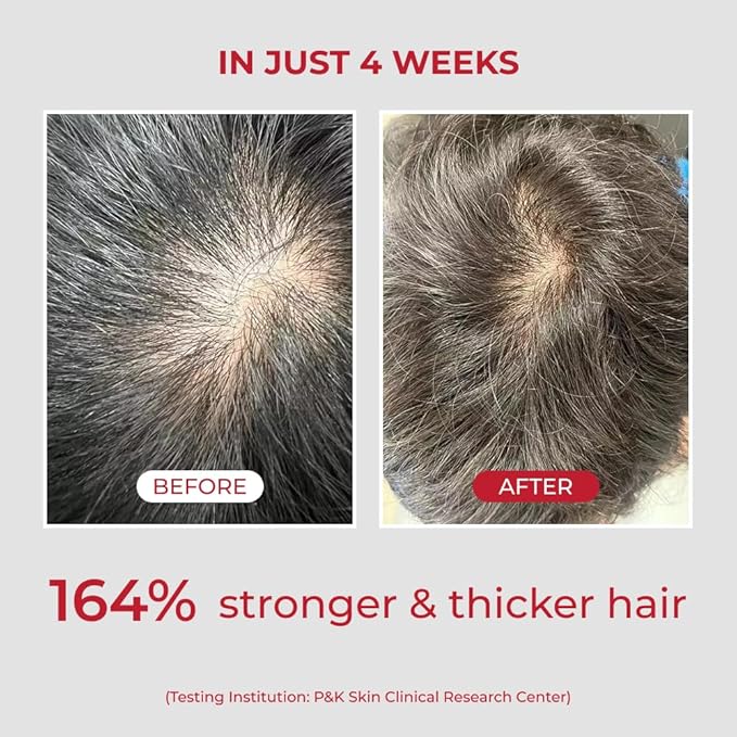 MOEV ANNURCATIN Shampoo and Conditioner Set for Men and Women, Korean Biotin Hair Growth Volumizing Shampoo, Paraben-Free Natural Apple Wash-Off Hair Mask, Rose Thickening for Damaged Hair