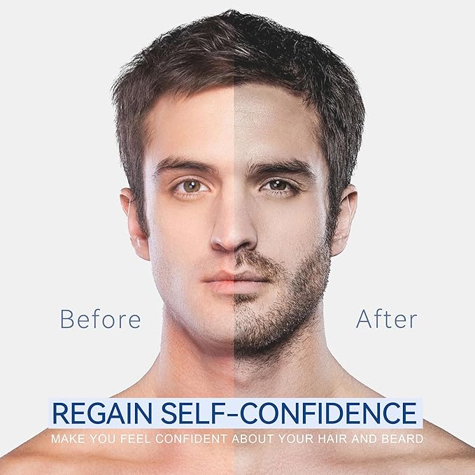 5% Minoxidil Foam for Men, 5% Biotin and 5% Minoxidil Use for Hair Growth, Slows Hair Loss and Promotes Hair Regrowth, 1 Month Supply