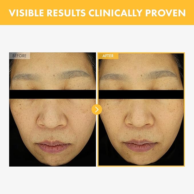 TOSOWOONG 8 Days Spot Cream, Dark Spot Remover for Face, Age Spot, Sun Spot, Freckles, Melasma, Brown Spot Serum, Advanced Formula Corrector Cream with Niacinamide for Women and Men, 50g, 1.76 oz.