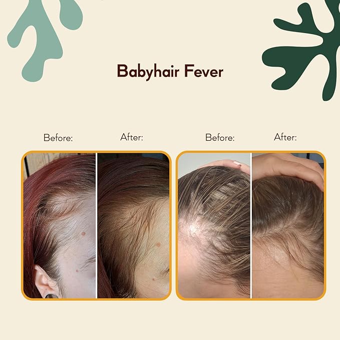 HairTry Babyhair Fever - Thinning Hair Treatment Women - Hair Serum for Hair Loss Prevention - Scalp Serum with Vitamin B Complex, Biotin & Caffeine - Hair Loss Solutions – Net 6.76 Fl. Oz/ 200 ml