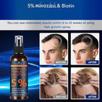 Minoxidil for Men Beard Growth Kit, Minoxidil for Women Hair Growth Kit, Hair Loss Treatments for Women Hair Regrowth Treatment, Minoxidil 5%