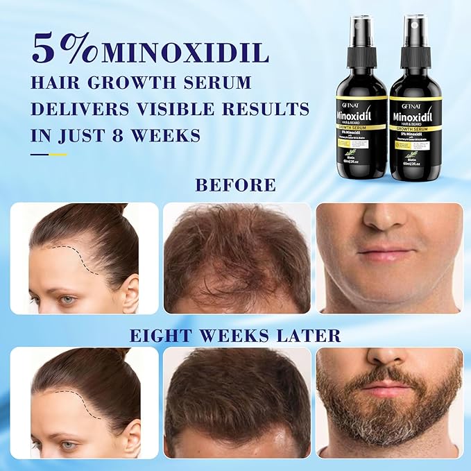5% Minoxidil Spray for Men and Women Hair Loss Solution with Biotin and Rosemary Hair Growth Serum (Glass Bottle), Extra Strength 5 Percent Minoxidil for Thicker Fuller Hair Regrowth Treatments