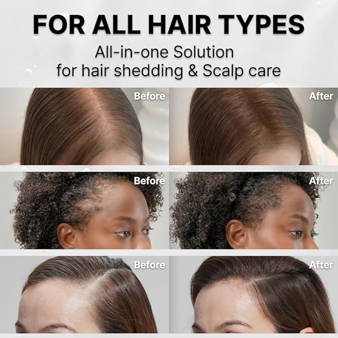 lilyeve GROWTURN Hair Growth Serum with Built-in Brush, Heartleaf-Derived Exosomes to Revitalize Hair, Hair Thickening, Hair Growth Accelerator - Korean Hair Care, 3.38 fl. oz. (Pack of 2)