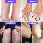 2 Packs Urea Cream 42% Plus Salicylic Acid 2%, 7.06Oz Lavender Foot Cream for Dry Cracked Heels Treatment Knees Elbows Hands Repair Treatment, Callus Remover for Feet, Foot Lotion for Dry Cracked Feet