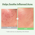 TOSOWOONG Azelaic Acid 10% Face Serum, Rosacea care, Redness Soothing and Blemish, Centella Asiatica for Acne-prone, Niacinamide, Hyaluronic Acid, Korean Skincare, Natural Color, 33 ml / 1.11 fl. oz.