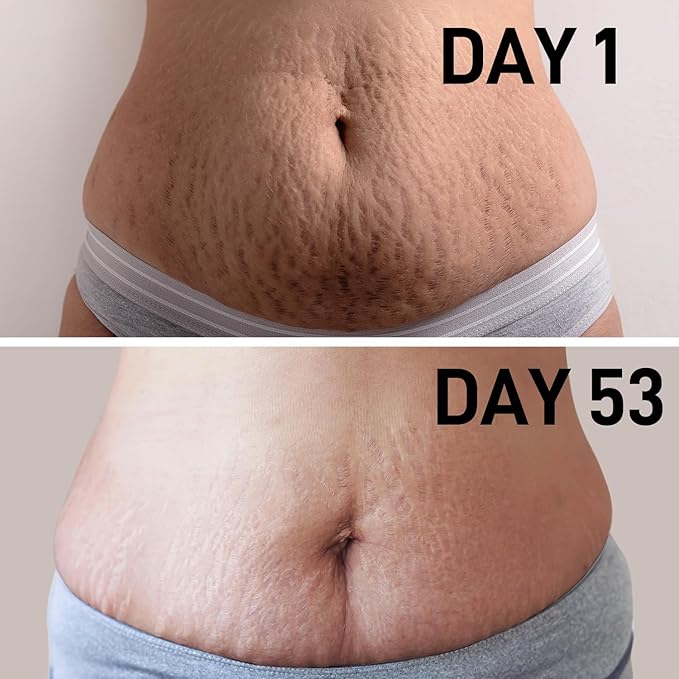 Stretch Mark Oil for Pregnancy & Body Oil for Pregnant Women, Morocco Nut Oil Help for Scars & Stretch Marks Removal & Prevention, Belly Cream for Repair, Firming & Smoothing Fine Lines (2Pack/150ml)