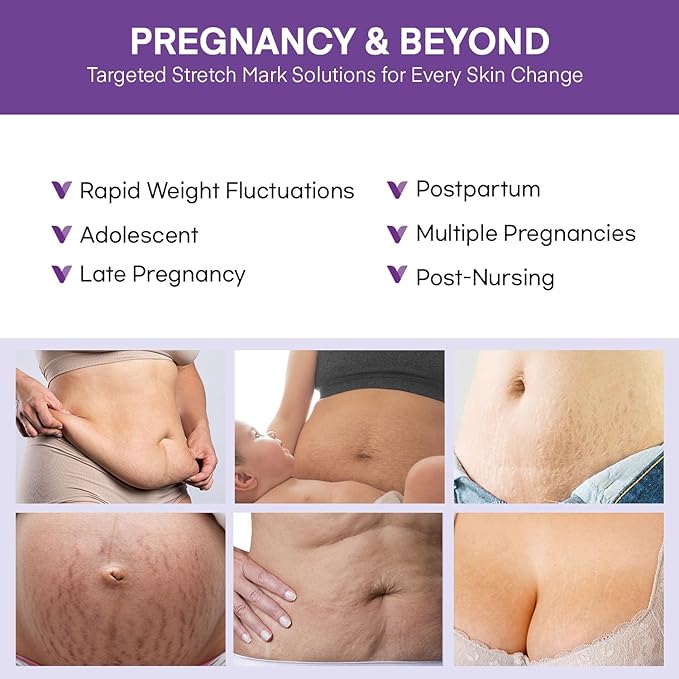 Stretch Mark Cream for Pregnant Women: Stretch Mark Treatment for Pregnancy - Belly Butter For Pregnant Women - Massage Lotion To Prevent And Repair Maternity Stretch Marks Scar - 4 Oz
