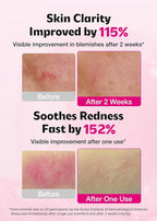 ISOI Blemish Care Up Serum for Face, Vegan Hydrating Serum for Smooth & Glass Skin Effect, Skin Barrier & Moisture Balance for Women, Arbutin & Rose Otto Oil, Korean Skin Care (1.18 fl. oz, 35ml)