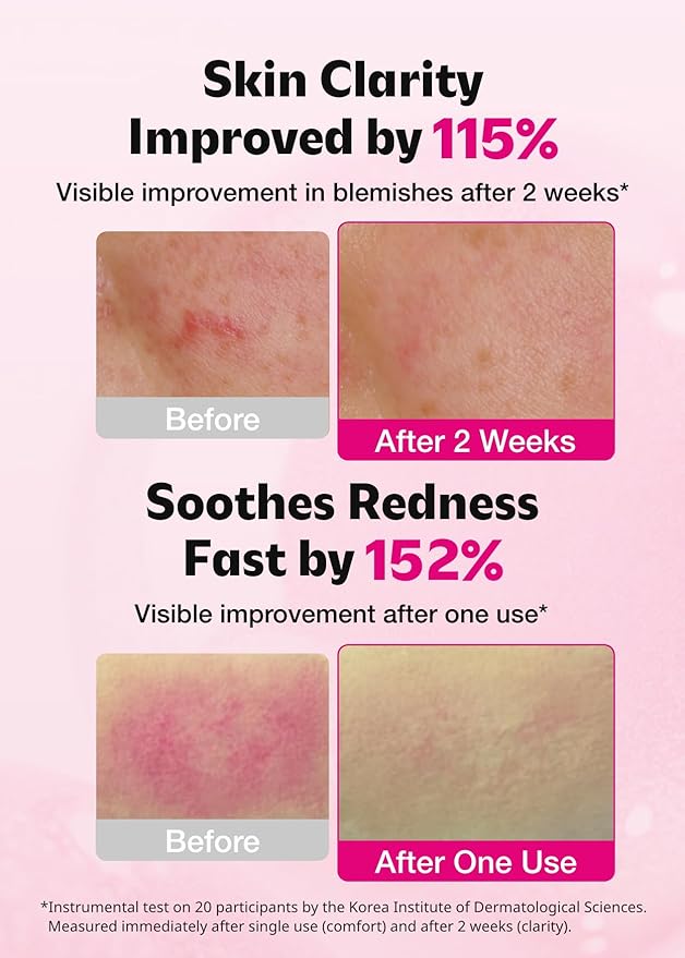 ISOI Blemish Care Up Serum for Face, Vegan Hydrating Serum for Smooth & Glass Skin Effect, Skin Barrier & Moisture Balance for Women, Arbutin & Rose Otto Oil, Korean Skin Care (2.36 fl. oz, 70ml)