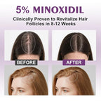 5% Minoxidil Spray for Women-4 PCS ，monoxide for men hair Infused with Biotin, hers hair regrowth treatment, Supports Thicker and Fuller Hair & Beard (13oz, 7 Month Supply)