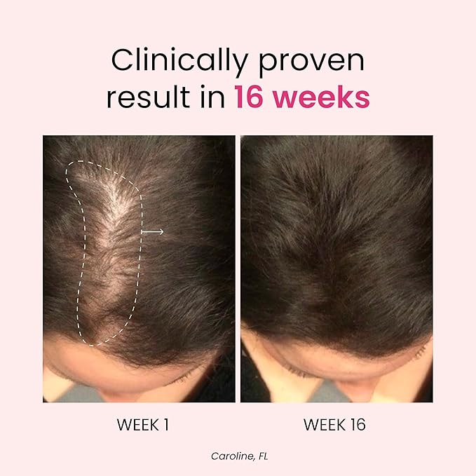 Trybello Hair Growth & Anti-Stress Gummies for Women | Powered by AnaGain — Plant-Based Biotin | Sugar-Free, Vegan Hair Supplements | Gluten-Free Gummy Vitamins for Thicker Healthier Hair | 60 Gummies