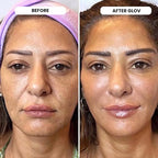 Glov Beauty Micro Infusion System for Face & Lips – 0.25mm 24k Gold Cosmetic Facial Stamp with Hyaluronic Acid, Collagen Peptides & Licorice Root Serum Ampoules (4x Infusion Application, 12x Serums)