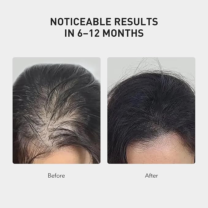 0.9% KX-826 KINTOR Hair Growth Spray,Strengthen Hair Nourish Hair follicles,Hair Care Products for Sparse Hair and Oily Hair Men&Women,240ml,Pro