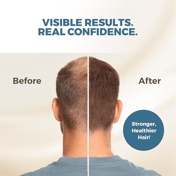 HAIRMETTO Saw Palmetto Extract Serum for Hair Loss, Hair Growth Serum with Stinging Nettle, Rosemary Oils and Peppermint Scent, Hair Serum for Men and Women - 4oz (118ml)