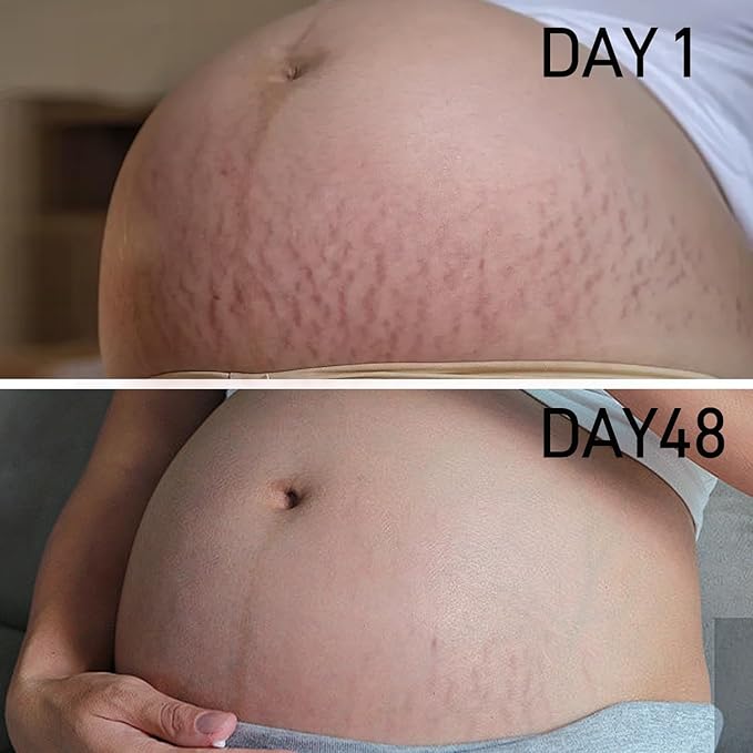 PEGO Stretch Mark Oil for Pregnancy, Maternity Body Oil for Stretch Mark Prevention & Reduction, Hydrating Skin Care, 2.03oz (1Pack)