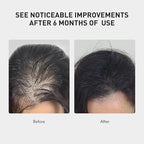 KINTOR 0.5% KX-826 Hair Growth Spray DHT Blocker Hair Regrowth Products,Nourish Hair follicles,Hair Oil Control Products For Men&Women,plant based 60ml