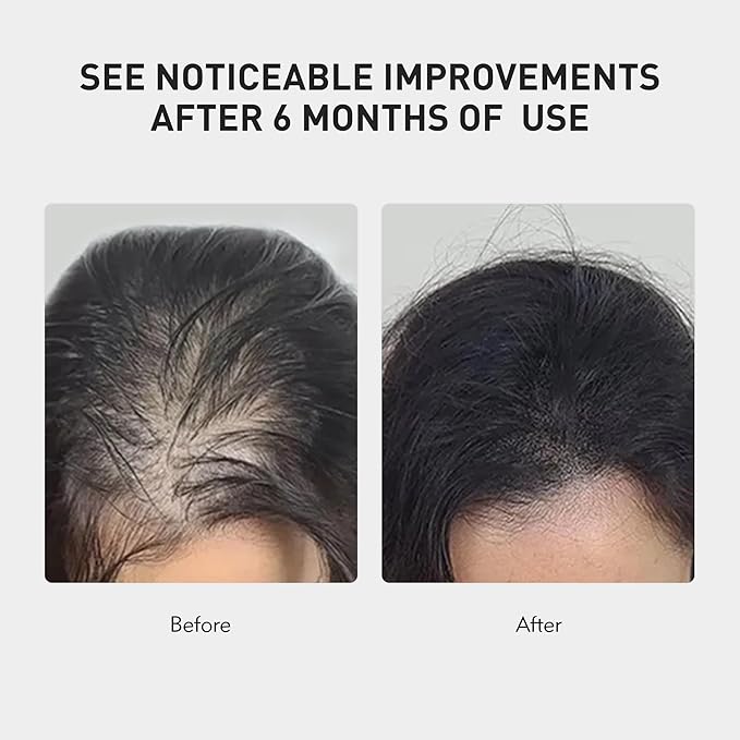 KINTOR 0.5% KX-826 Hair Growth Spray DHT Blocker Hair Regrowth Products,Nourish Hair follicles,Hair Oil Control Products For Men&Women,plant based 60ml